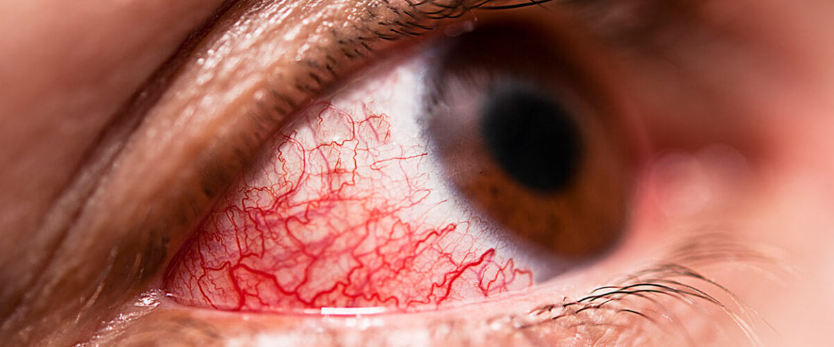 How To Treat Conjunctivitis
